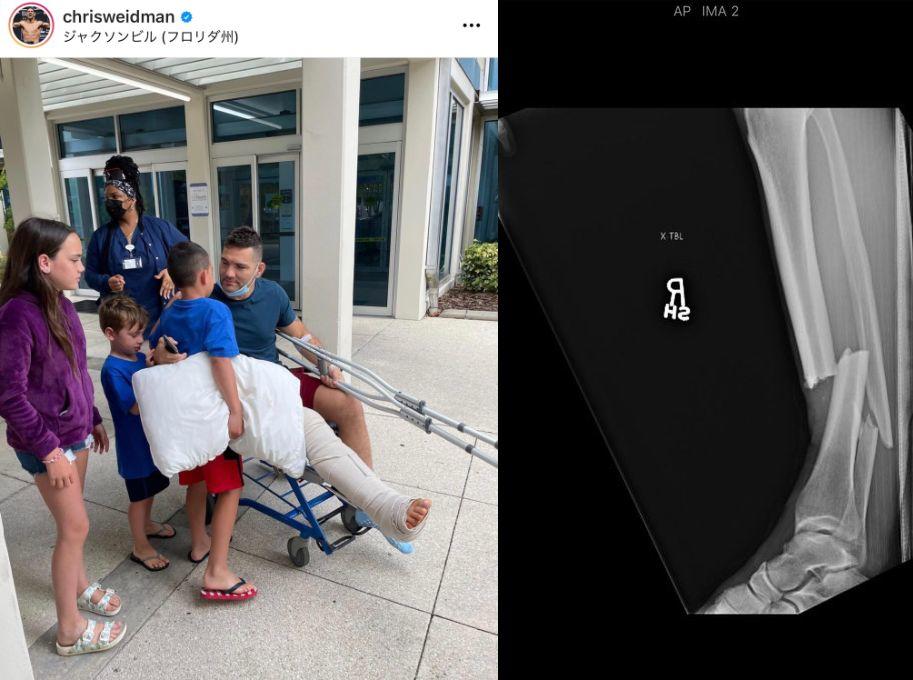 【UFC】足骨折のワイドマンが「ビフォーアフターのX線写真」を公開。無事退院し、ダナ代表のプライヴェートジェットで帰宅